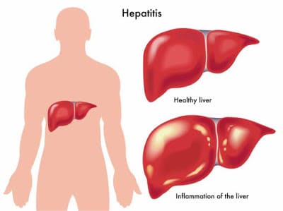 Hepatitis A B C 